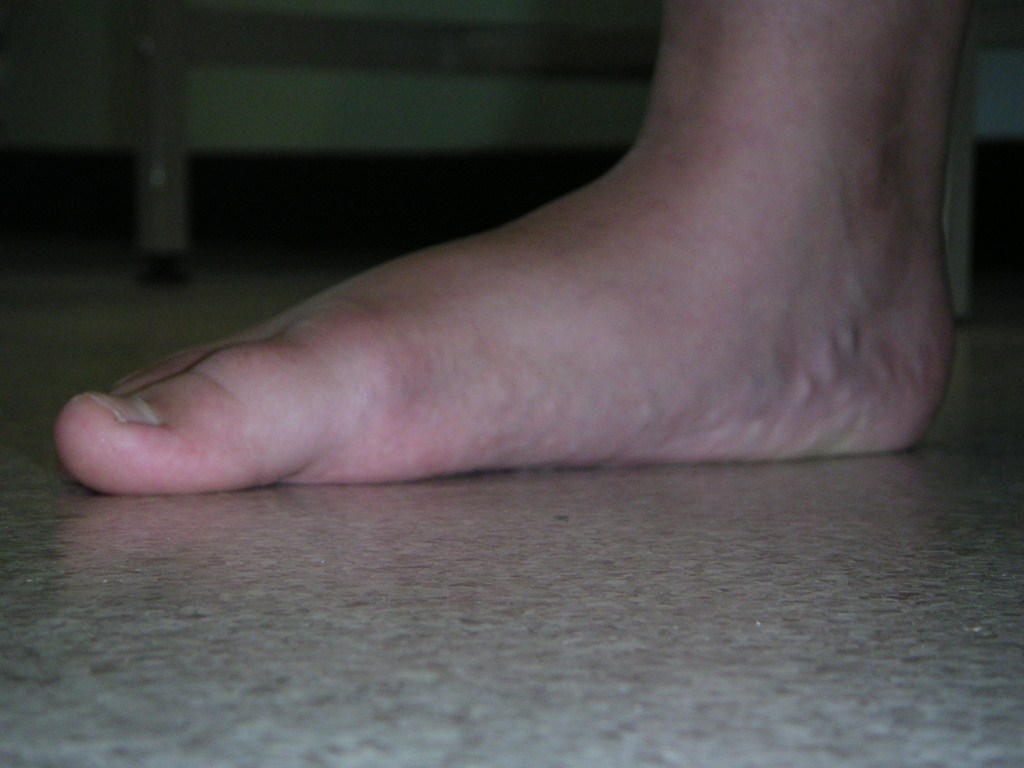 Flat Feet Doctor PMM